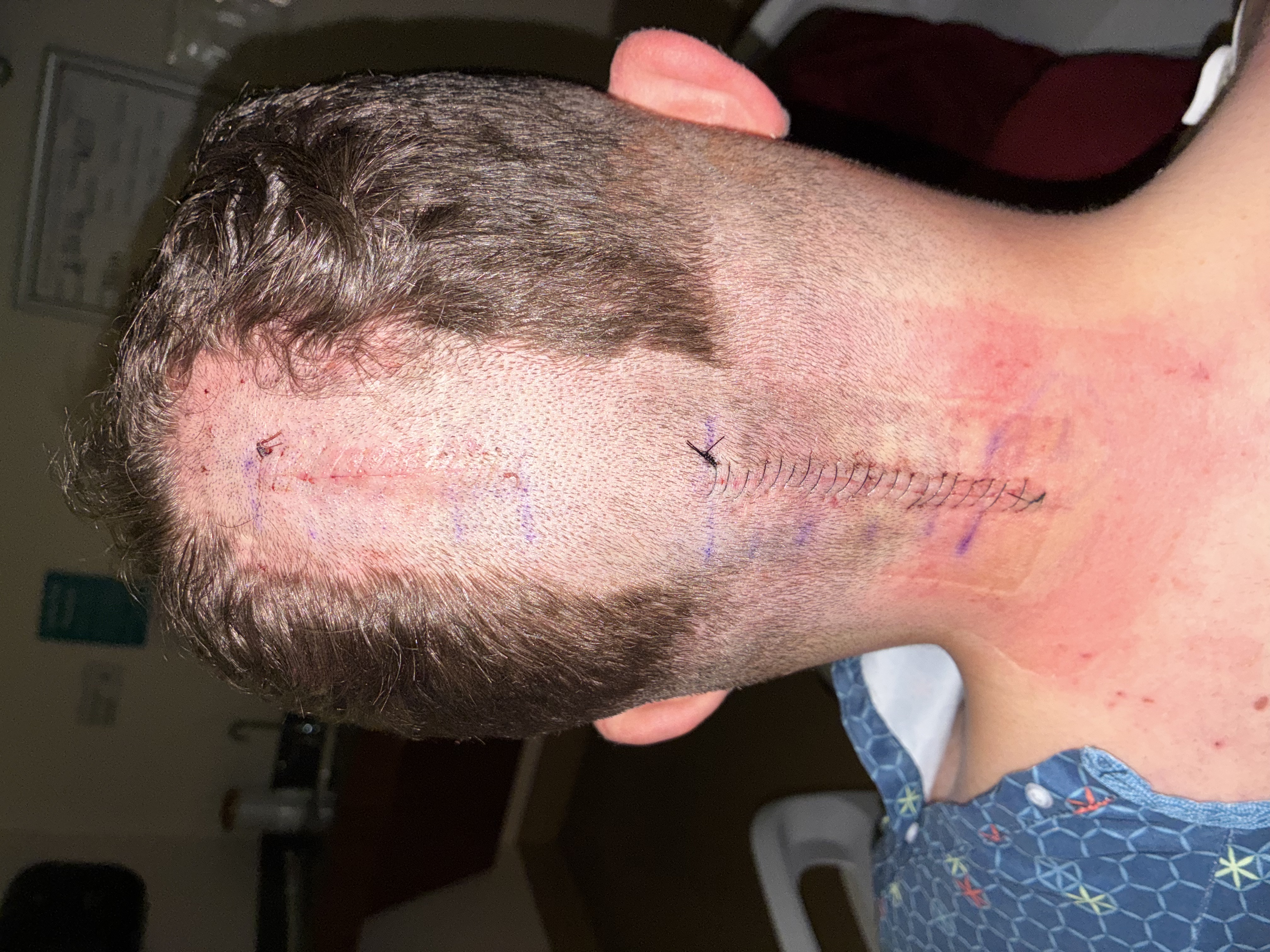 Back of Joe's head after headwrap removal — staples and incision visible