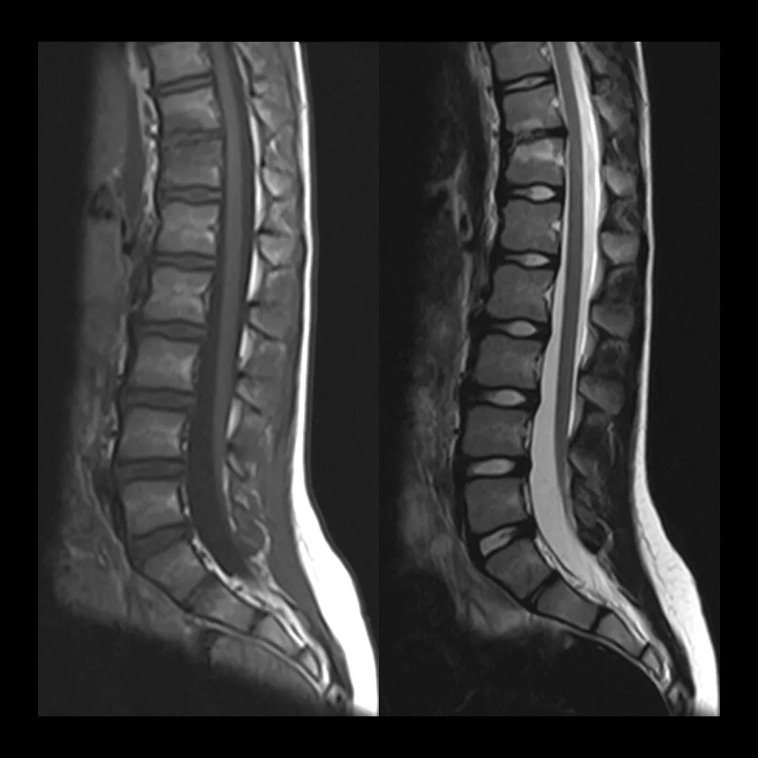 MRI comparison showing normal spinal cord versus tethered cord